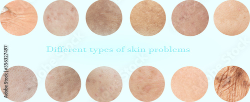 Different types of skin problems and wrinkles around the eyes and face. Dark spots. Melasma and freckles