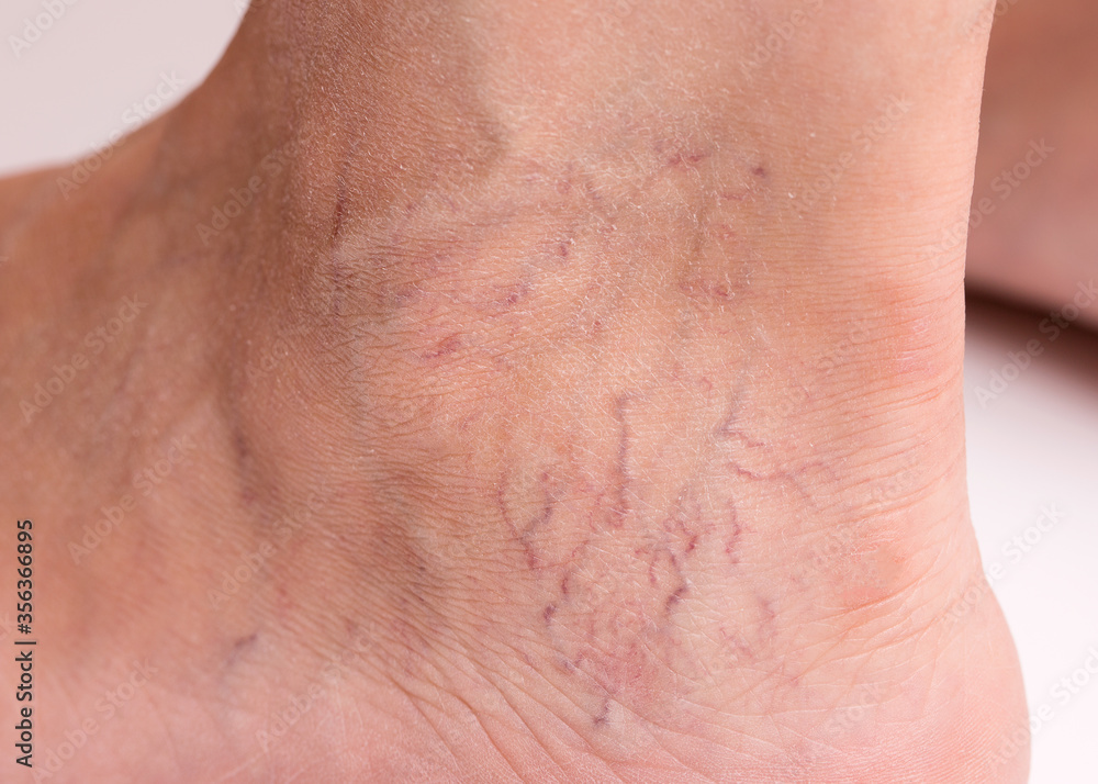 Varicose veins on the leg of a woman. Varicose veins on the leg close-up.
