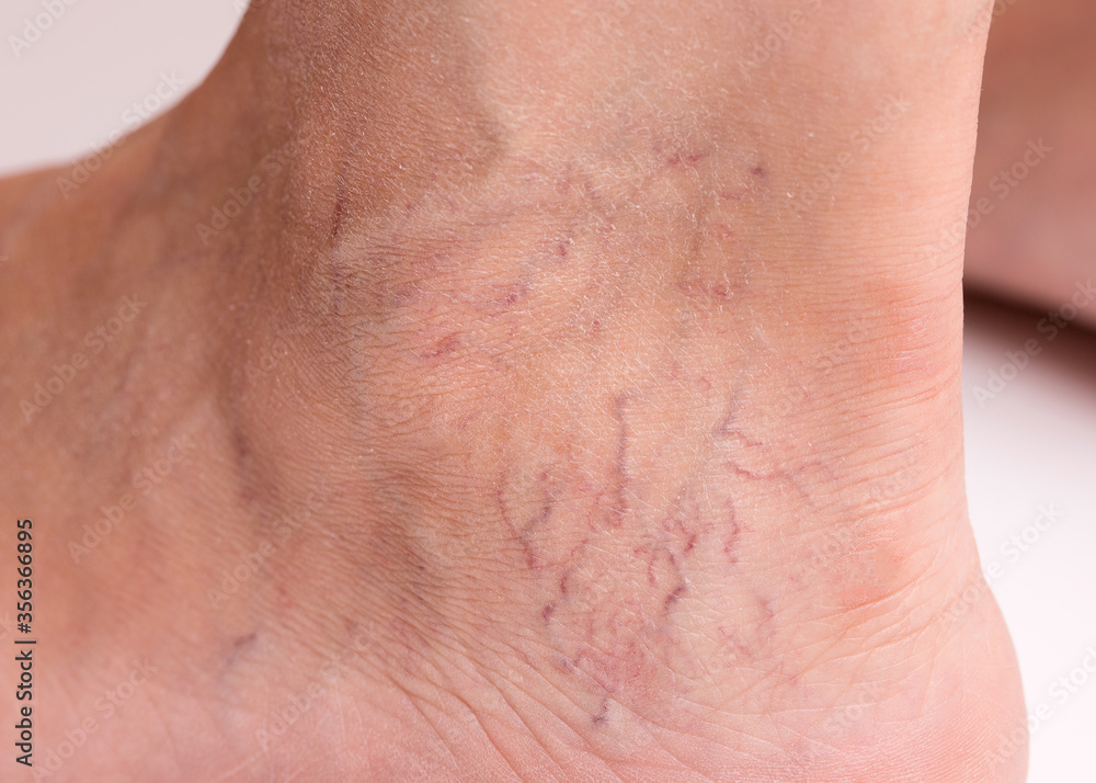 Naklejka premium Varicose veins on the leg of a woman. Varicose veins on the leg close-up.
