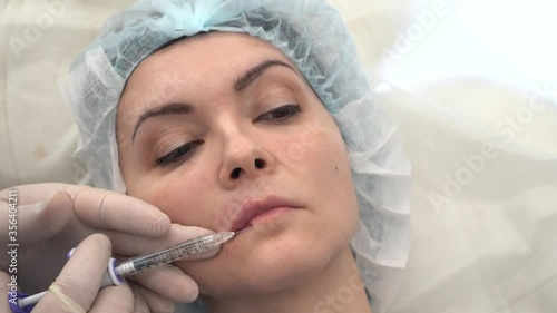 The doctor in white gloves makes a correction of the shape of the lips with the help of a filler photo