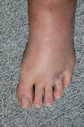 starke Schwellung und Hämatome des linken Fußes nach umknicken und Bänderdehnung