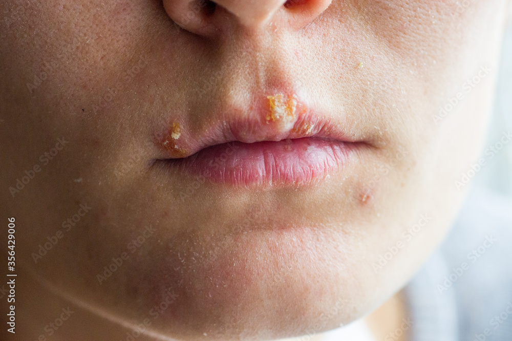 Herpes disease on the lips of a young girl. Wounds from herpes on the lips of a person. Herpes foci. Herpes disease on the lips of a young girl. Wounds from herpes on the lips of a person. Herpes foci.