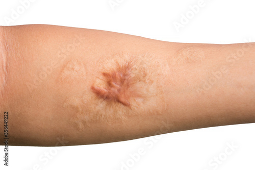 Close up Keloid scar (Hypertrophic Scar) on man arm skin after accident isolated on white background.