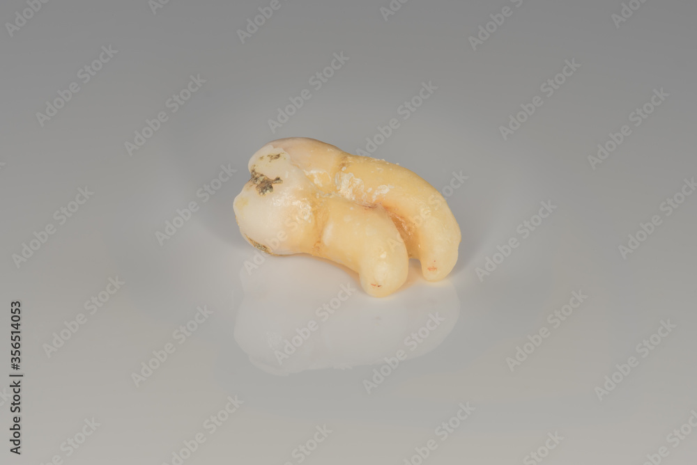 A closeup of a sectioning right lower third molar with curved root. (Adult tooth number 48) A closeup of a sectioning right lower third molar with curved root. (Adult tooth number 48)