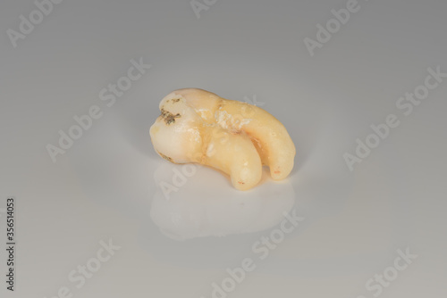 A closeup of a sectioning right lower third molar with curved root. (Adult tooth number 48)