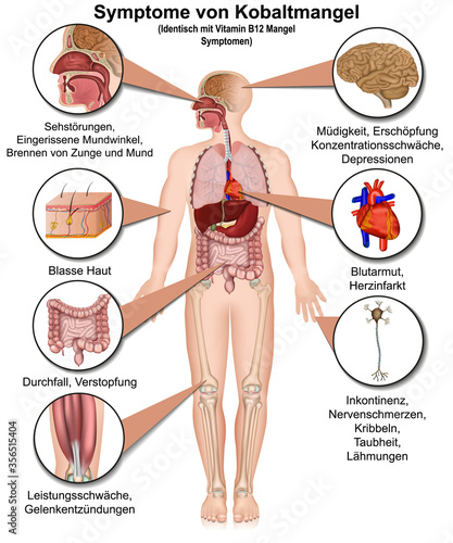 Symptome von Kobaltmangel, Infografik mit Beschreibung in deutsch, Spurenelement