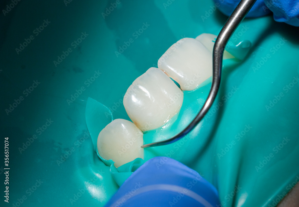 Inspection and treatment of anterior teeth at the dentist, cofferdam is