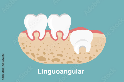 Wisdom tooth ( Linguoangular impaction ) illustration Vector.