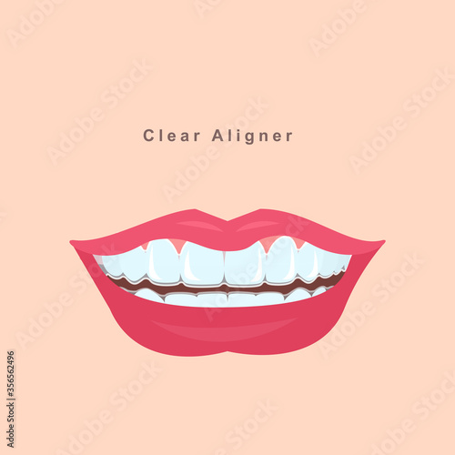 smile with aligners.