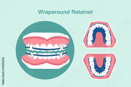 Wraparound Retainer