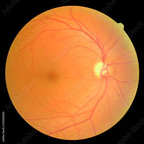 Fotografía retinal