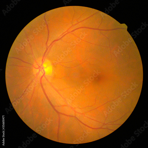 retinal