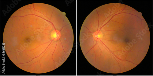 Photography retinal images
