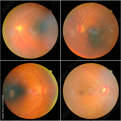 retinal images