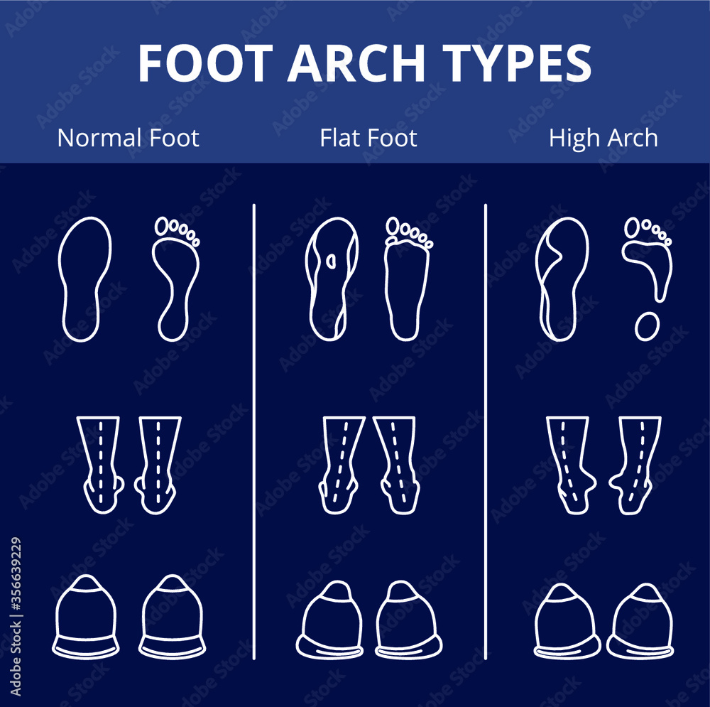 Foot arch types vector infographics. Set of flat foot, high arch Stock ...