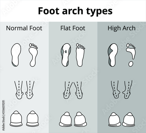 Foot arch types vector infographics. Set of flat foot, high arch