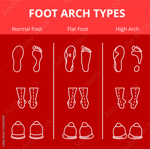 Foot arch types vector infographics. Set of flat foot, high arch