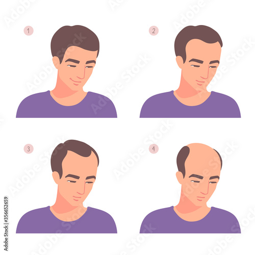 Stages of baldness progress, hair loss process. Portrait of a man losing his hair. Hairline receding. A vector cartoon illustration isolated on a white background.