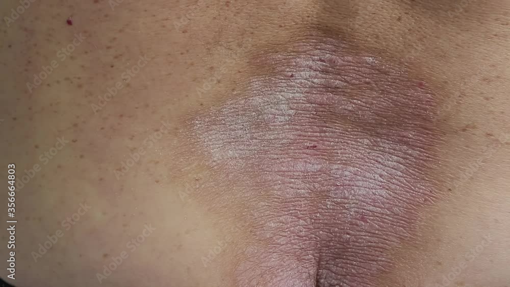 psoriasis a closeup of a man running his hand over an area of the