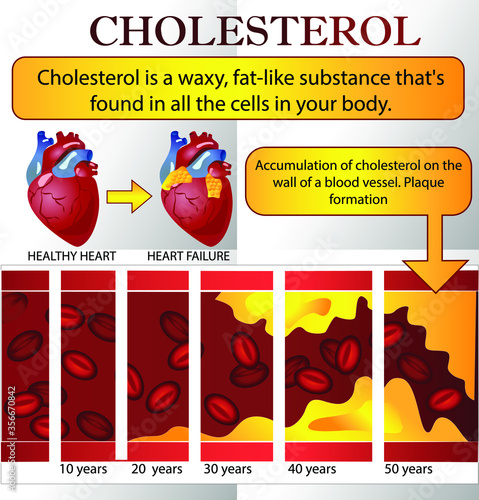Heart attack and atherosclerosis medical illustration: healthy and damaged heart, blood vessel section with fatty deposit accumulation