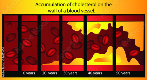 Cholesterol in artery, health risk , vector design. Medical banner for your web site.