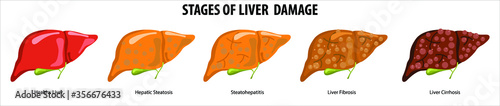 Stages of liver damage. Liver Disease. Healthy, fatty, liver fibrosis and Cirrhosis. Illustration isolated on white background. photo