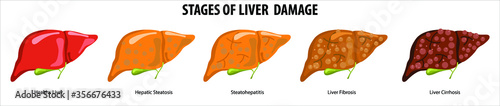 Stages of liver damage. Liver Disease. Healthy, fatty, liver fibrosis and Cirrhosis. Illustration isolated on white background.