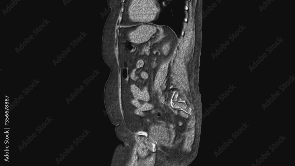 Voluminous MRI of the abdominal cavity, gastrointestinal tract, bladder