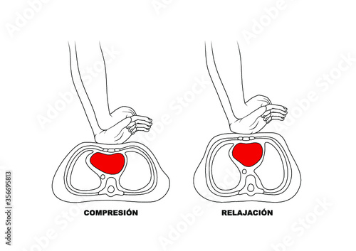 Compresión Relajación - RCP Reanimación Cardiopulmonar
