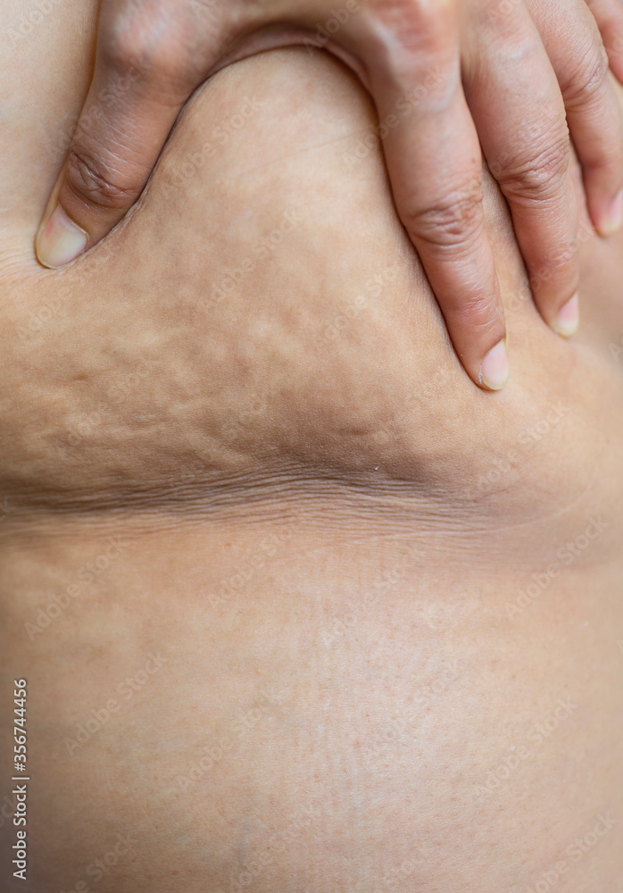 The sebaceous cellulite glands on the skin of women