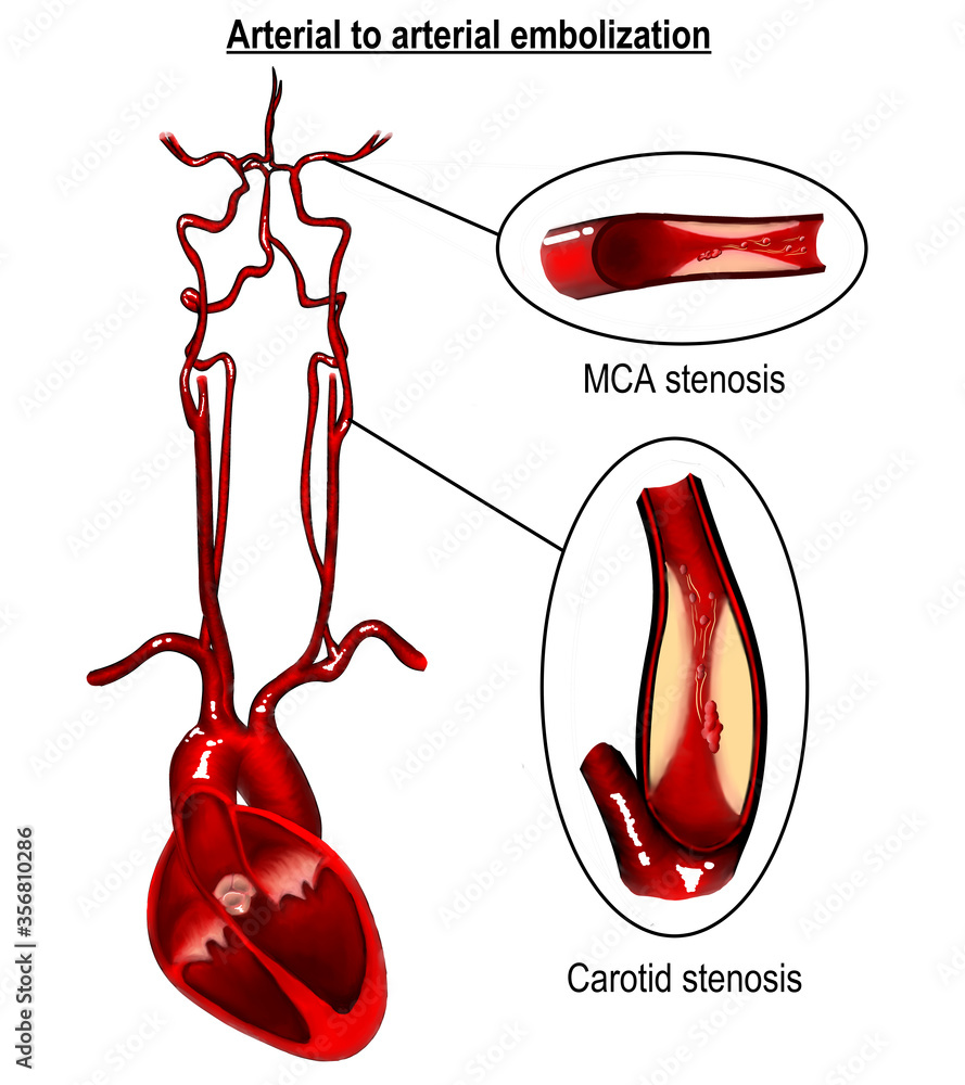 Carotid Stenosis And Intracranial Arterty Stenosis Are The Major And