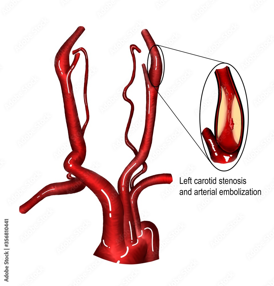 Carotid artery stenosis and artery to artery embolization. Stock ...