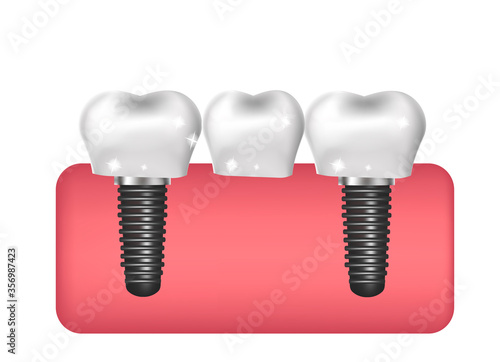 Dental implants, bridge construction, prosthetics 3D realistic style. Dentistry, healthy teeth concept. Vector illustration