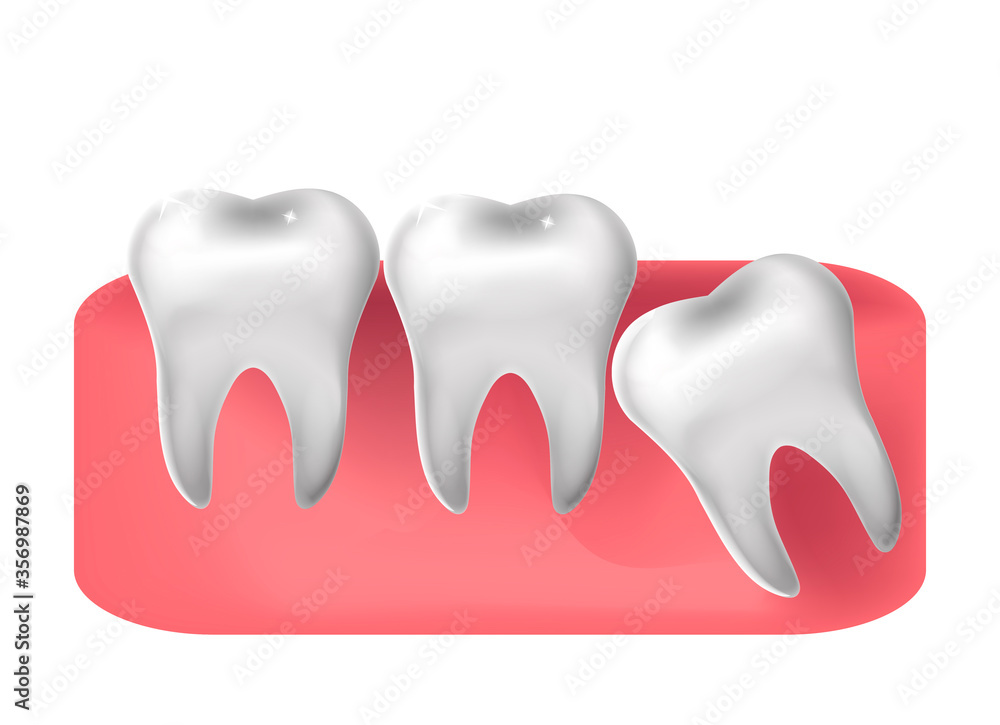 Wisdom tooth cut through, 3d realistic style. Dentistry, wisdom teeth extraction concept. Vector illustration Wisdom tooth cut through, 3d realistic style. Dentistry, wisdom teeth extraction concept. Vector illustration