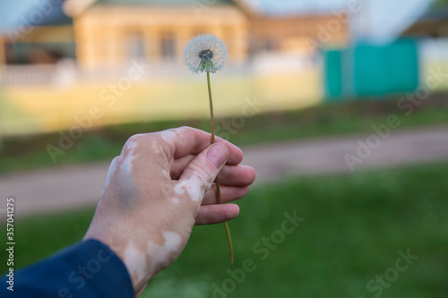 left hand with vitiligo skin pigmentation holding a dandelion