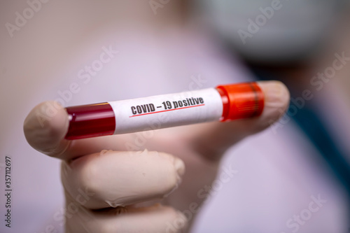 2019-nCoV Coronavirus. Positive Blood Sample in Doctors Hand. Respiratory Syndrome. Coronavirus outbreaking