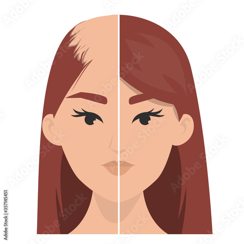 Hair transplantation before and after vector isolated. Alopecia treatment, forget about baldness. Hairless woman.