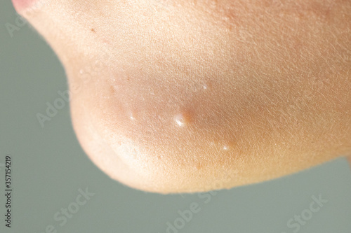 Close-up of Molluscum Contagiosum also called water wart. Viral formations in the chin on the skin of the child.