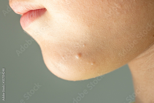 Close-up of Molluscum Contagiosum also called water wart. Viral formations in the chin on the skin of the child. photo