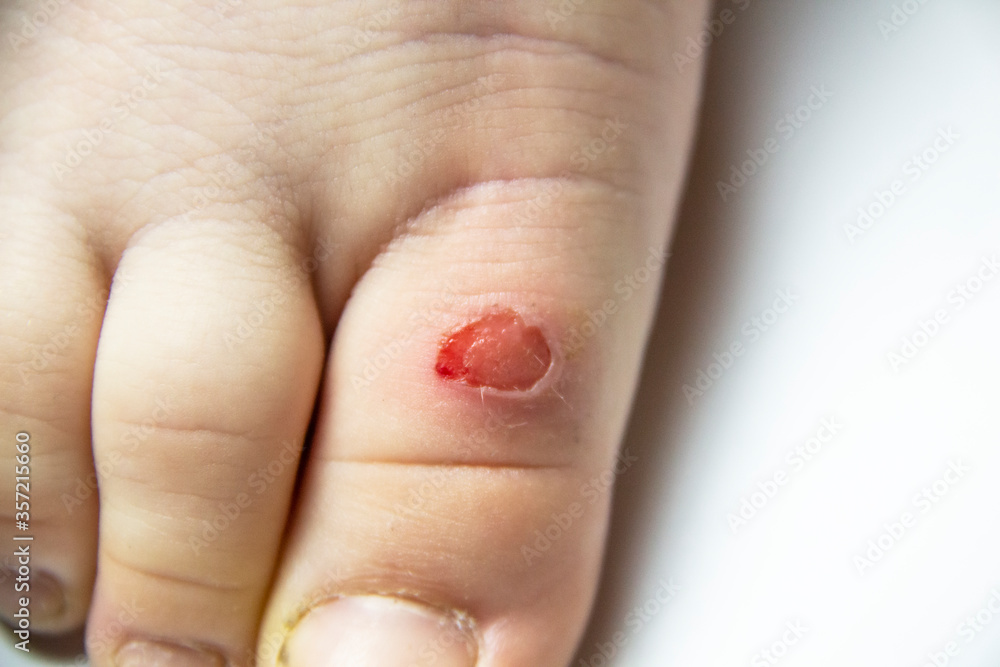 Callus on the leg of a young boy. children foot with problem areas on the skin, dry callus, bad nails. Leg wound from the callus. Callus on the leg of a young boy. children foot with problem areas on the skin, dry callus, bad nails. Leg wound from the callus.