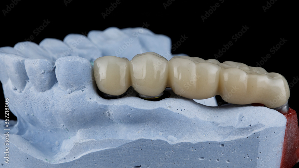 dental temporary prosthesis of the chewing part made of polymer - dental plastic, side view on a black background dental temporary prosthesis of the chewing part made of polymer - dental plastic, side view on a black background