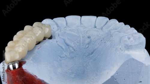 dental temporary prosthetic chewing part made of polymer