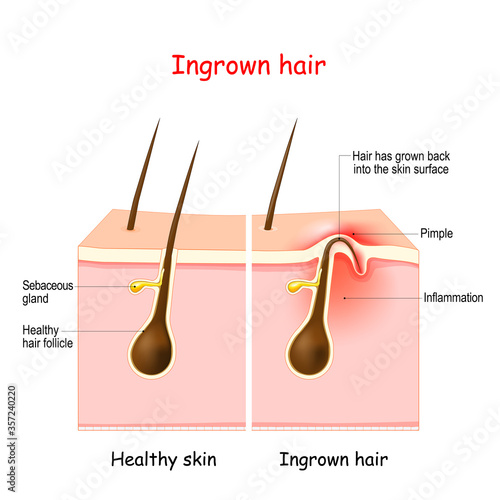 Ingrown hair