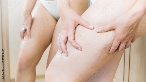 Closeup image of cellulite and stretch marks on female hips and legs. Concept of overweight, weight loss and dieting