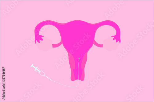 Vector illustration of intrauterine insemination (IUI)