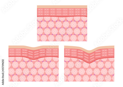 collagen in younger skin and aging skin , 3 type collagen skin version.