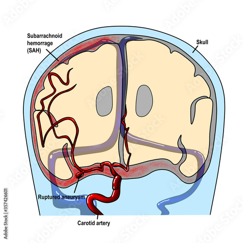 Subarrachnoid hemorrhage is one of the hemorhagic stroke causing high mortality. 