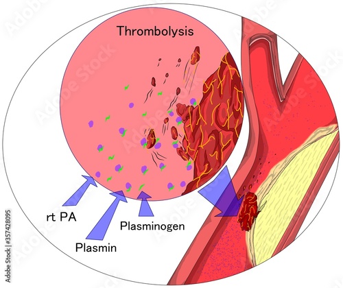 The mechanism of thrombolytic drug. photo