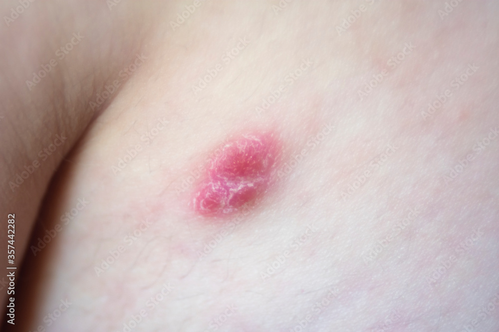 Fototapeta premium macro closeup of a Caucasian male patient shoulder with a Psoriasis skin lesion (first lesion)