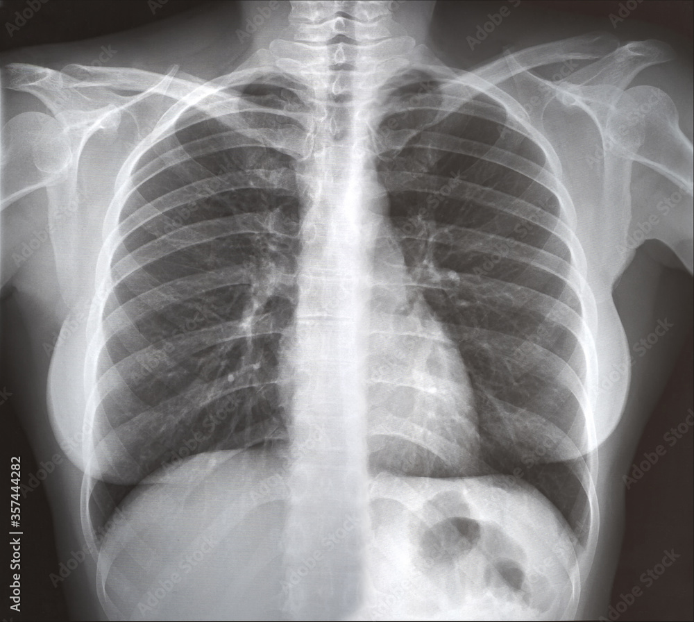 Chest x-ray for examination by a doctor, light infection, orthopedics and exclusion of injuries. Chest x-ray for examination by a doctor, light infection, orthopedics and exclusion of injuries.